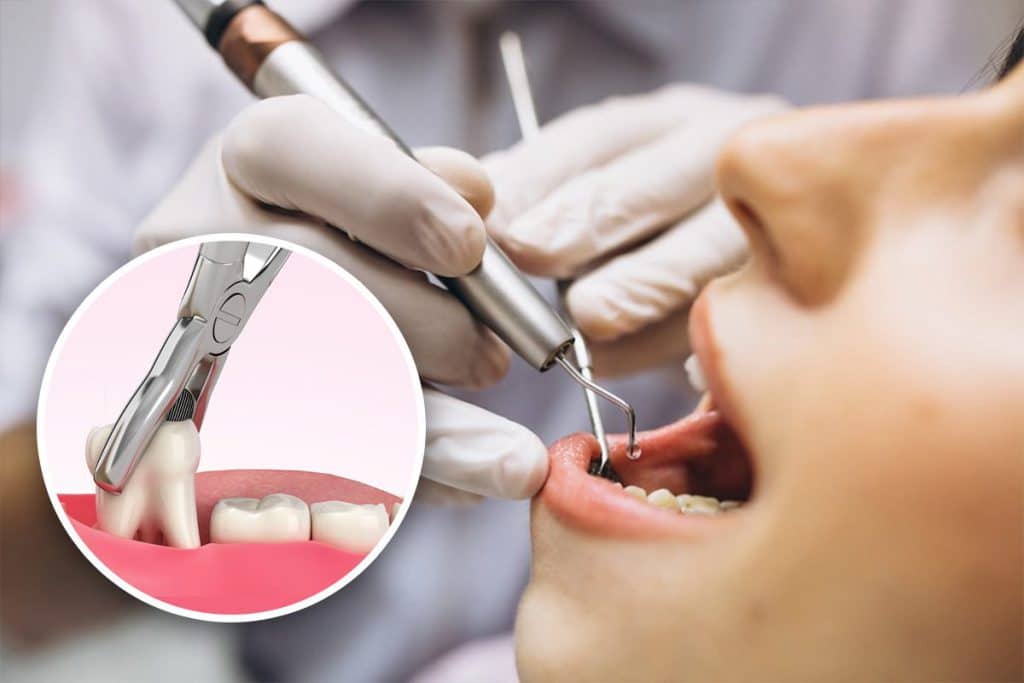 Tooth Extraction