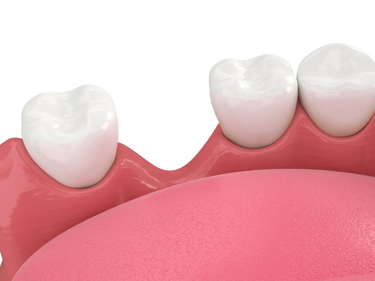 My Crown Fell Out — Is This a Dental Emergency?